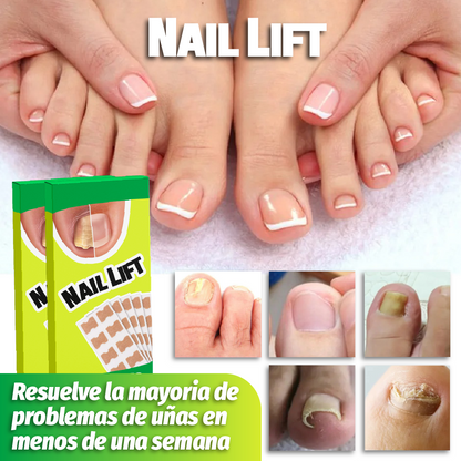 NailLift™ - Parches para Uñas Encarnadas