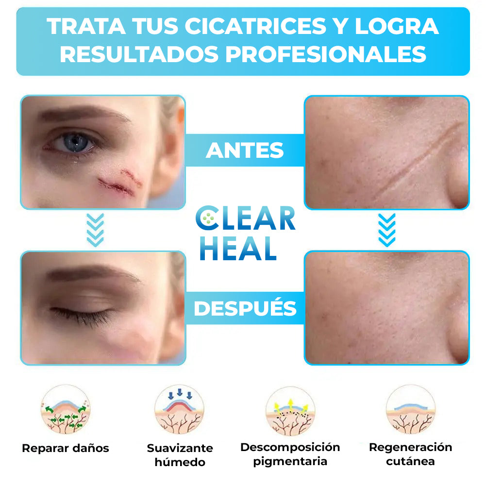 ClearHeal™ - Cinta de silicona para cicatrices