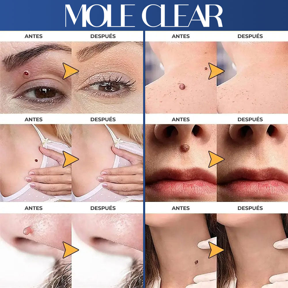 MoleClear™ - Lapiz de plasma para eliminar lunares